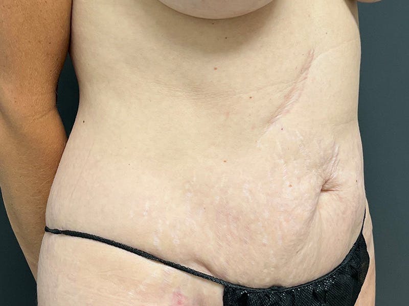Mini Tummy Tuck Before & After Gallery - Patient 284453 - Image 4