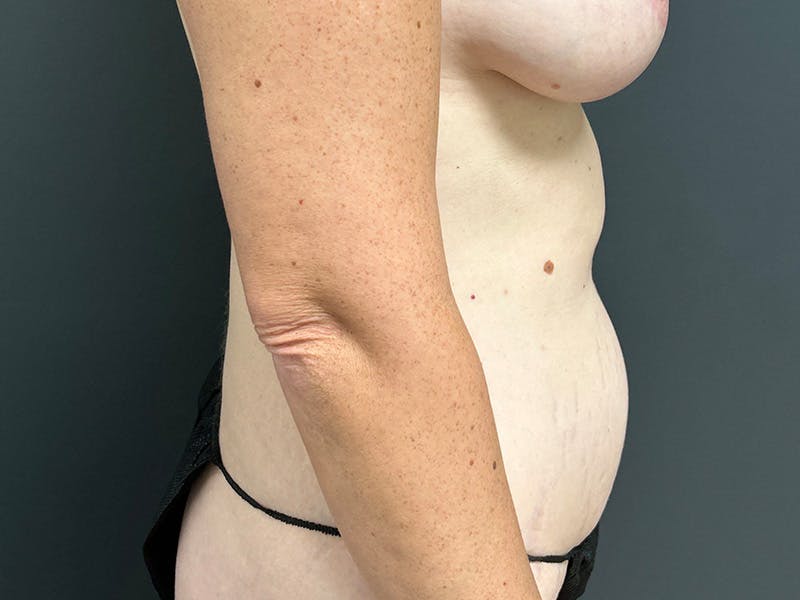 Tummy Tuck Before & After Gallery - Patient 328270 - Image 5