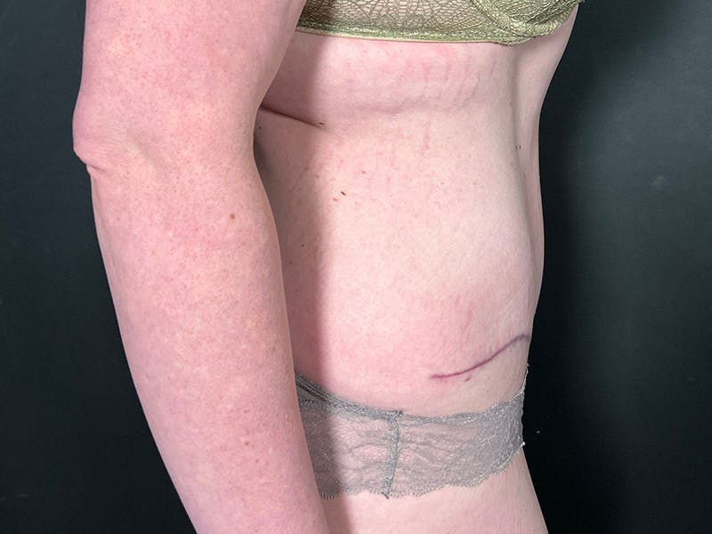 Tummy Tuck Before & After Gallery - Patient 404858 - Image 6