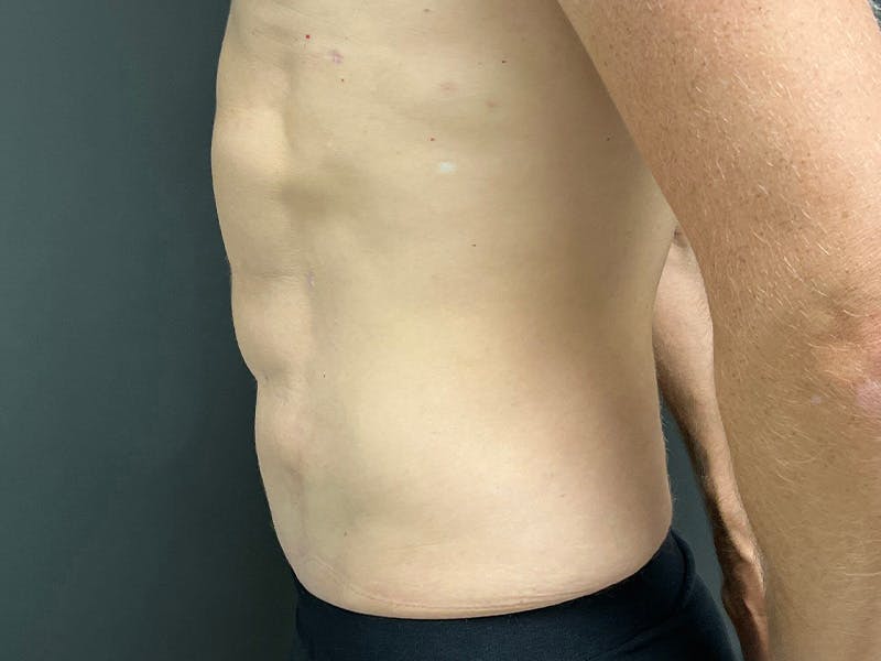 Abdomen Before & After Gallery - Patient 406127 - Image 10