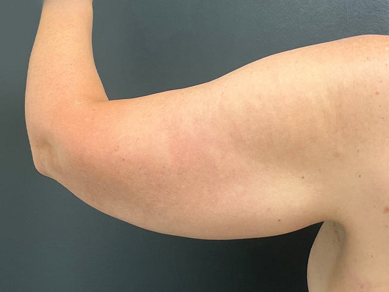 Arm Lift Before & After Gallery - Patient 460783 - Image 7
