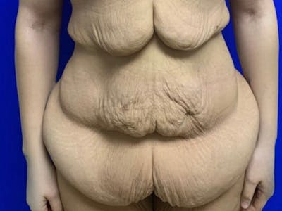 Tummy Tuck Before & After Gallery - Patient 102921 - Image 1