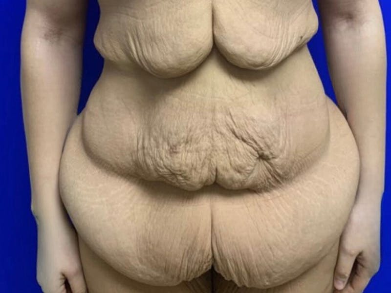 Tummy Tuck Before & After Gallery - Patient 102921 - Image 1