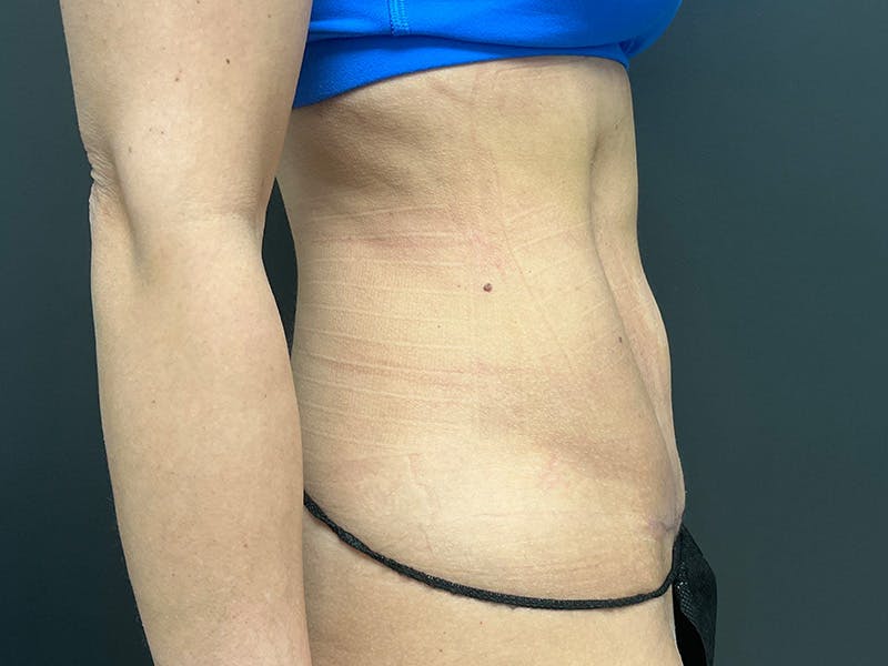 Mini Tummy Tuck Before & After Gallery - Patient 120272 - Image 6