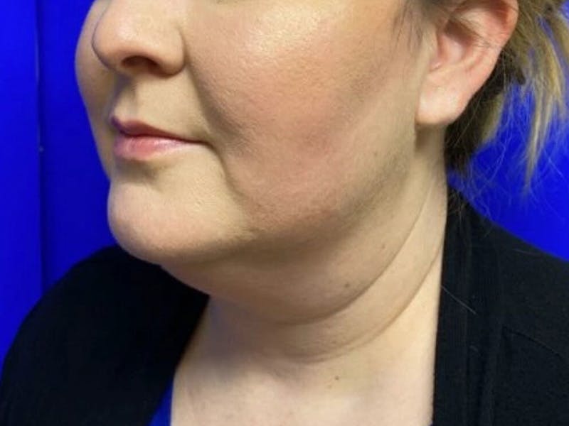 Submental Before & After Gallery - Patient 120511 - Image 7