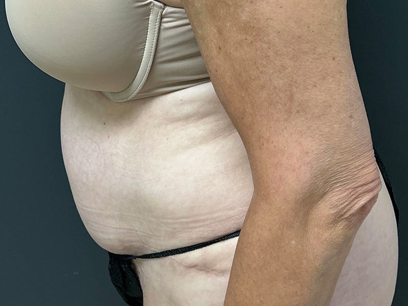 Abdomen Before & After Gallery - Patient 784997 - Image 9