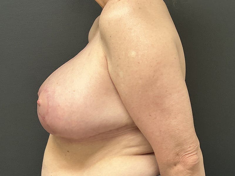 Breast Reduction Before & After Gallery - Patient 275306 - Image 8