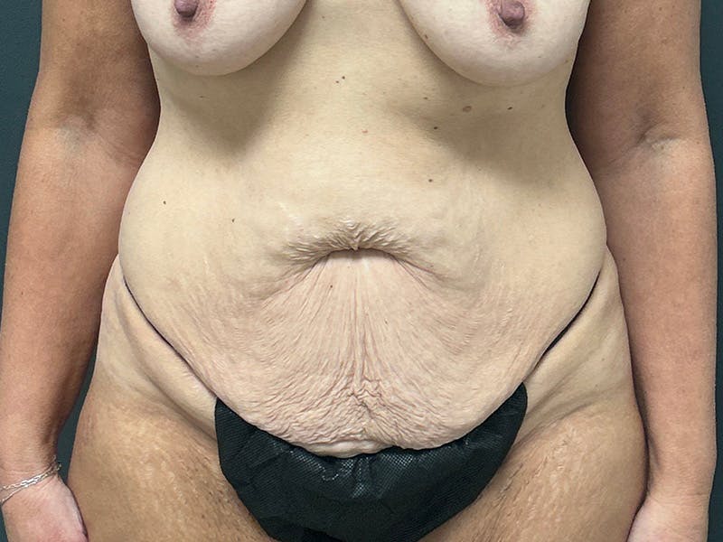 Tummy Tuck Before & After Gallery - Patient 215602 - Image 1