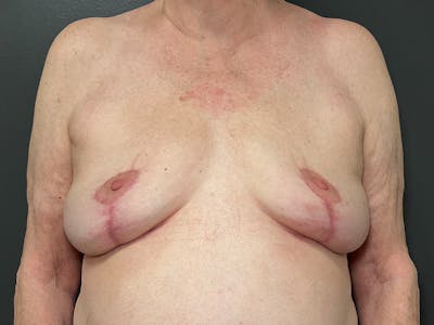 Breast Reconstruction Before & After Gallery - Patient 165209 - Image 2