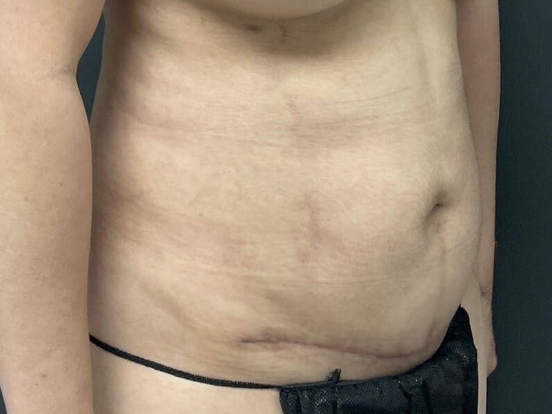 Abdomen Before & After Gallery - Patient 153440 - Image 4