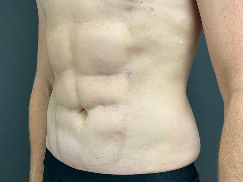 Mini Tummy Tuck Before & After Gallery - Patient 264633 - Image 8