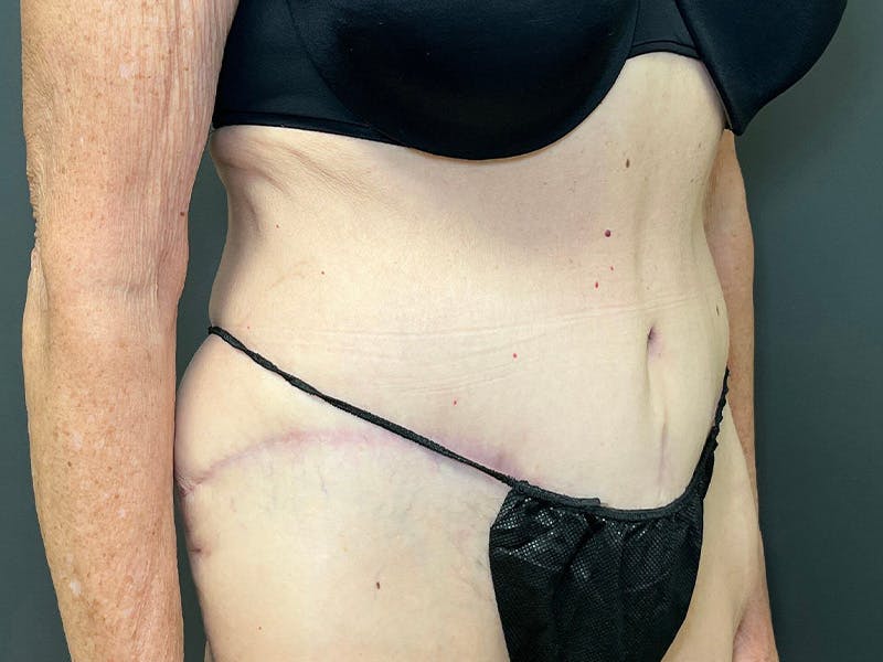Tummy Tuck Before & After Gallery - Patient 394420 - Image 4