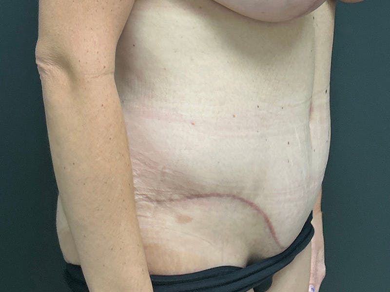 Abdomen Before & After Gallery - Patient 924975 - Image 4