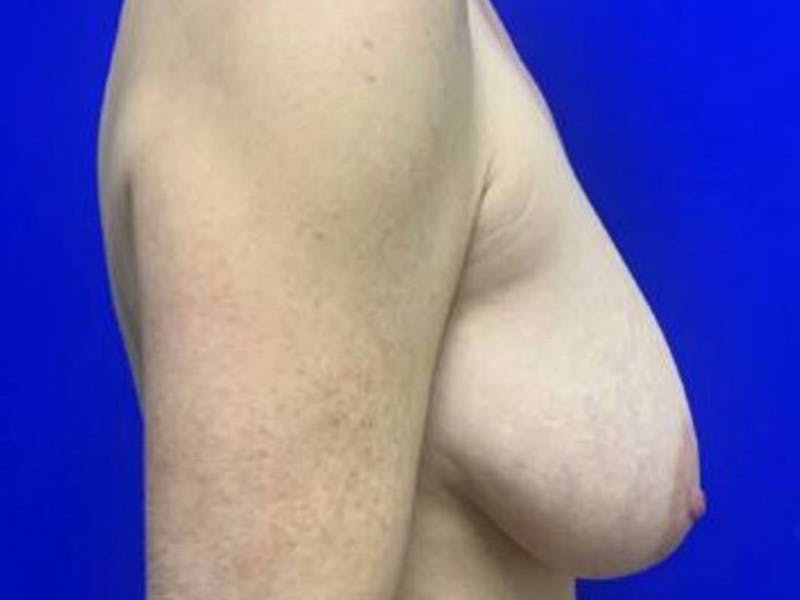 Mastopexy (Breast Lift) Before & After Gallery - Patient 402414 - Image 5