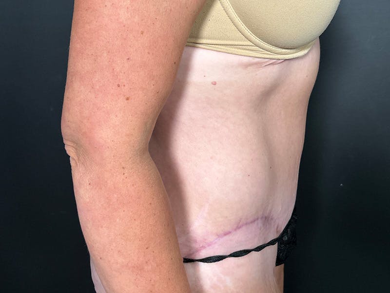 Tummy Tuck Before & After Gallery - Patient 165824 - Image 6