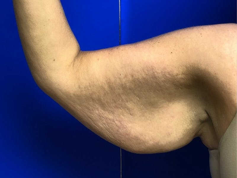 Arm Lift Before & After Gallery - Patient 256451 - Image 7