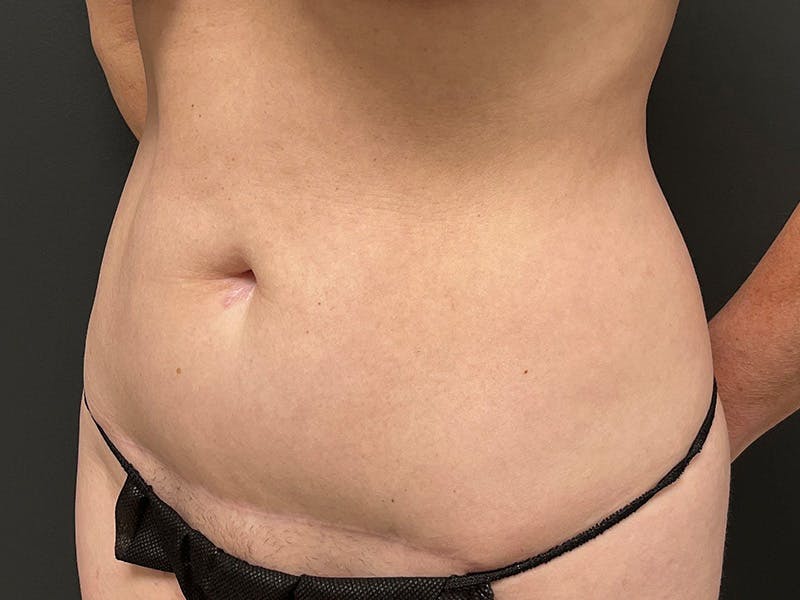 Mini Tummy Tuck Before & After Gallery - Patient 491163 - Image 7