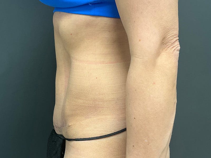 Abdomen Before & After Gallery - Patient 158442 - Image 10