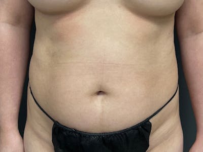 Mini Tummy Tuck Before & After Gallery - Patient 263277 - Image 1