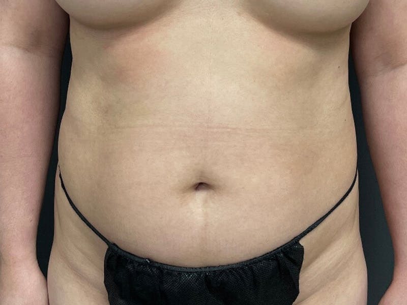 Mini Tummy Tuck Before & After Gallery - Patient 263277 - Image 1