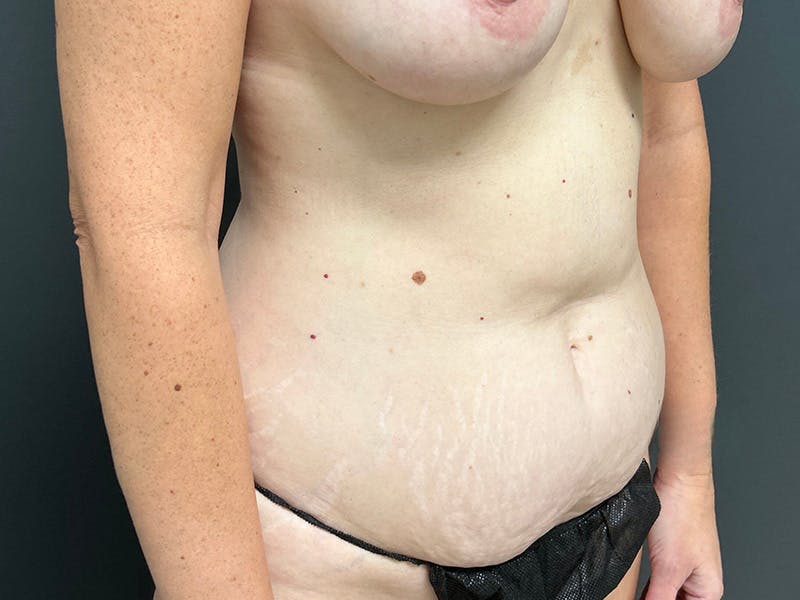Tummy Tuck Before & After Gallery - Patient 328270 - Image 3