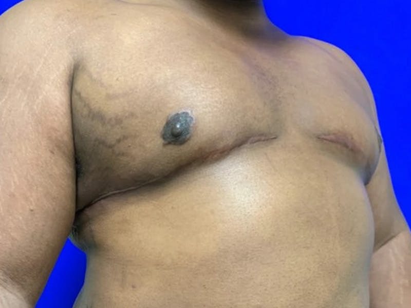 Gynecomastia Before & After Gallery - Patient 150764 - Image 4
