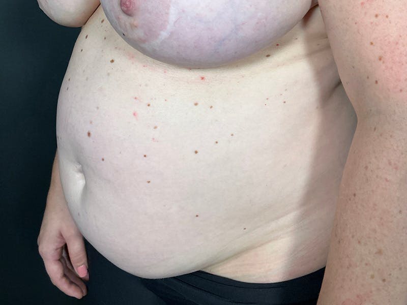 Abdomen Before & After Gallery - Patient 419008 - Image 7