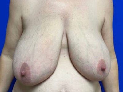 Breast Reduction Before & After Gallery - Patient 101592 - Image 1