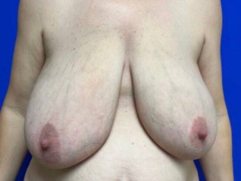 Breast Reduction Before & After Gallery - Patient 101592 - Image 1