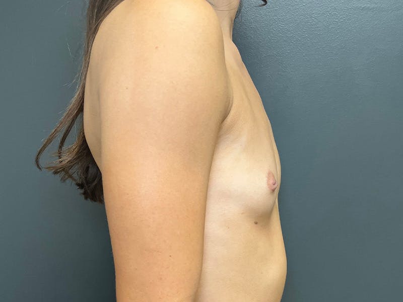 Breast Augmentation Before & After Gallery - Patient 940468 - Image 5