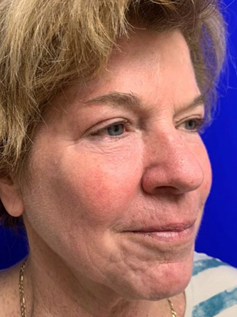 Brow Lift Before & After Gallery - Patient 256609 - Image 4