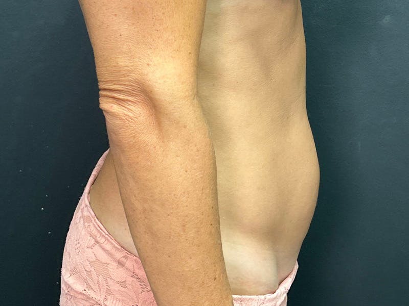 Mini Tummy Tuck Before & After Gallery - Patient 246074 - Image 5