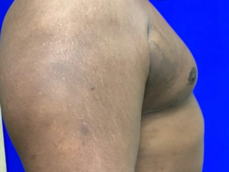 Gynecomastia Before & After Gallery - Patient 150764 - Image 6