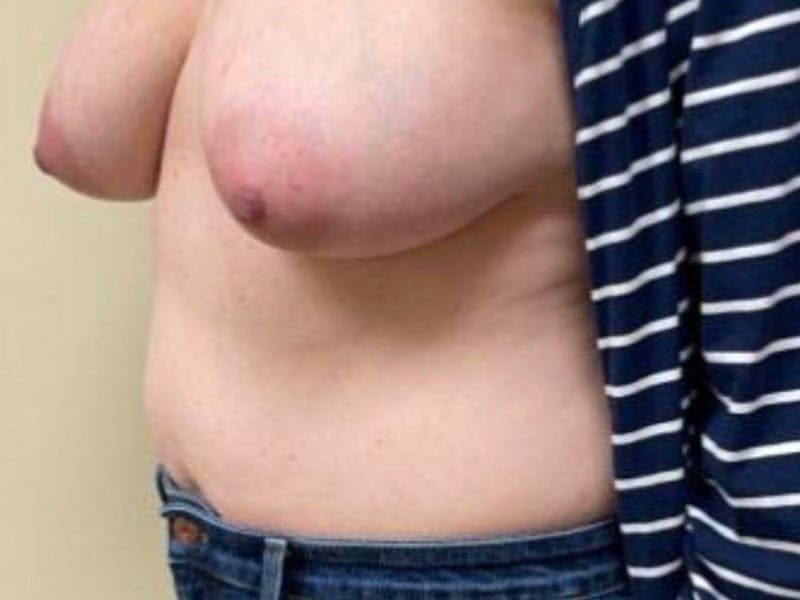 Abdomen Before & After Gallery - Patient 332408 - Image 7