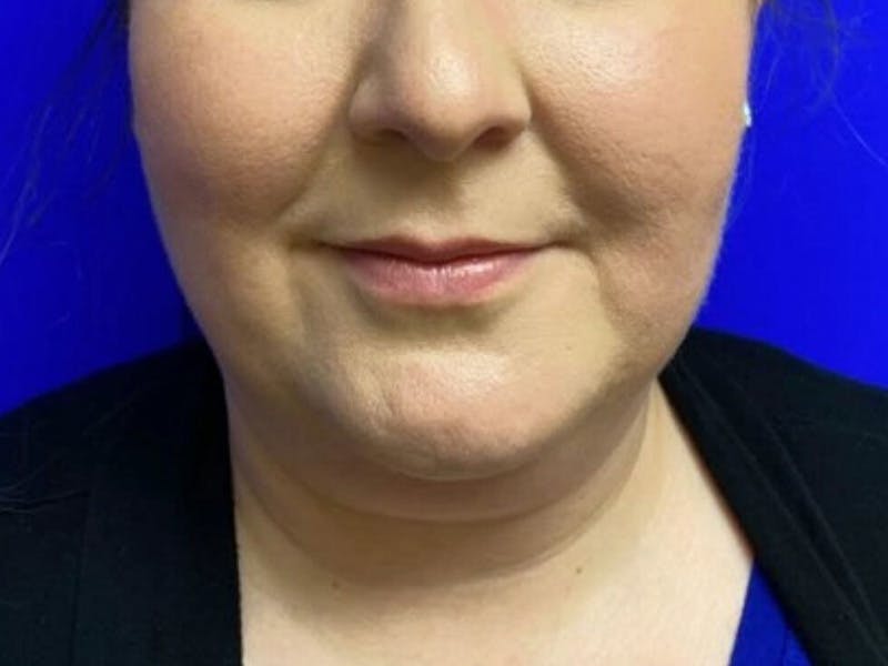Submental Before & After Gallery - Patient 120511 - Image 5
