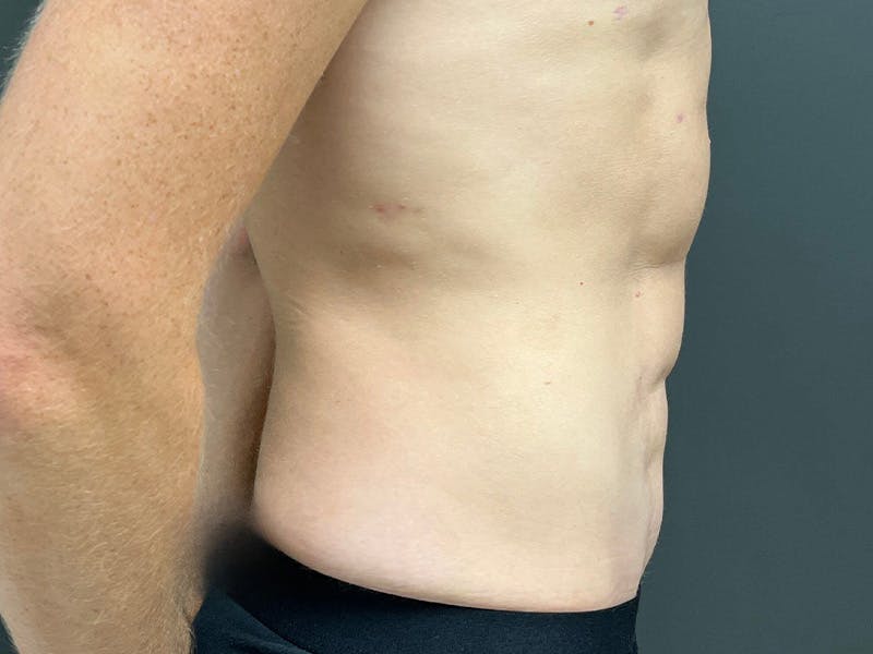 Mini Tummy Tuck Before & After Gallery - Patient 264633 - Image 6