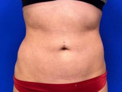 Tummy Tuck Before & After Gallery - Patient 266737 - Image 2