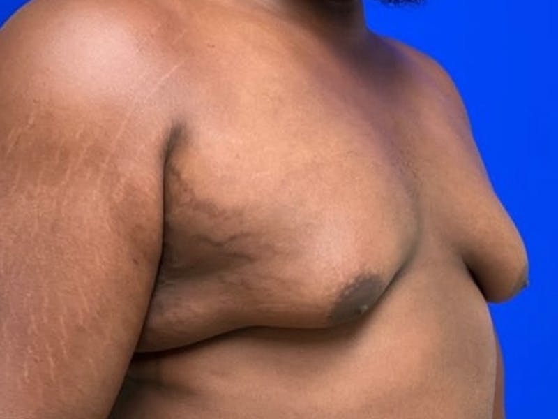 Gynecomastia Before & After Gallery - Patient 150764 - Image 3