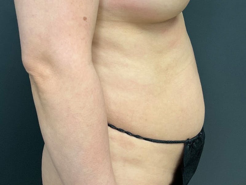 Abdomen Before & After Gallery - Patient 153440 - Image 5