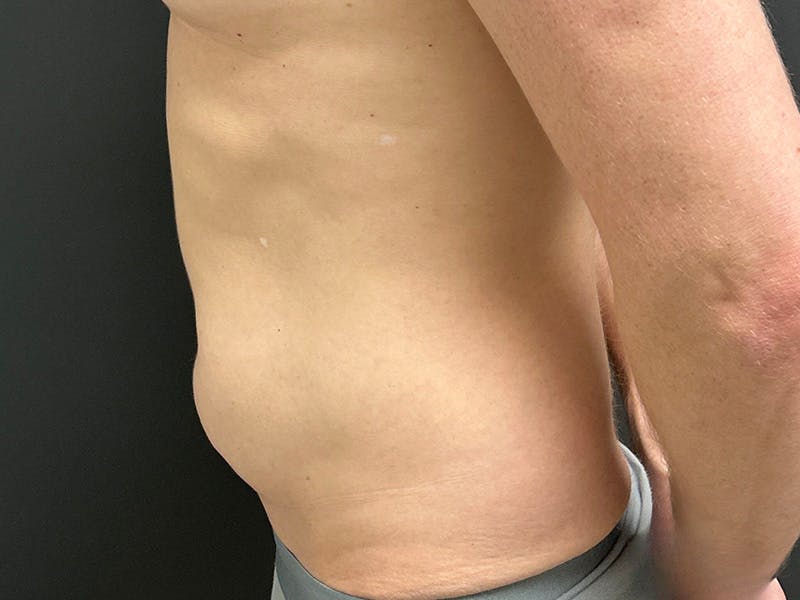 Abdomen Before & After Gallery - Patient 406127 - Image 9
