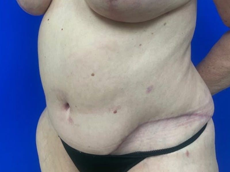 Tummy Tuck Before & After Gallery - Patient 548883 - Image 4