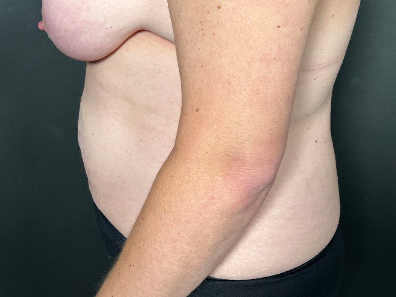 Abdomen Before & After Gallery - Patient 924975 - Image 9