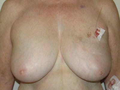 Breast Reconstruction Before & After Gallery - Patient 304817 - Image 1