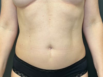 Abdomen Before & After Gallery - Patient 151954 - Image 2