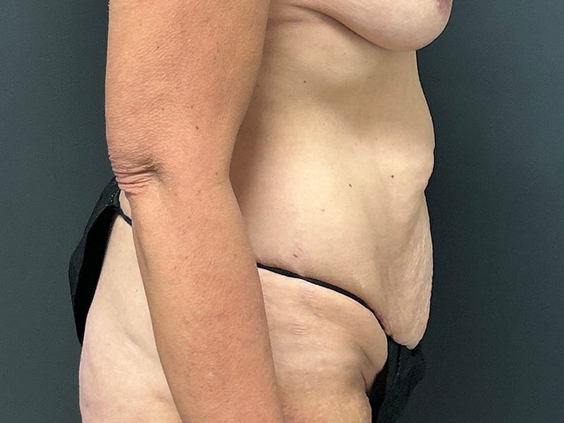 Tummy Tuck Before & After Gallery - Patient 215602 - Image 5