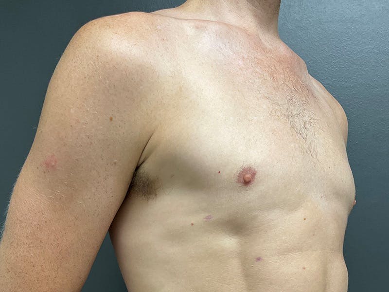 Gynecomastia Before & After Gallery - Patient 376405 - Image 4