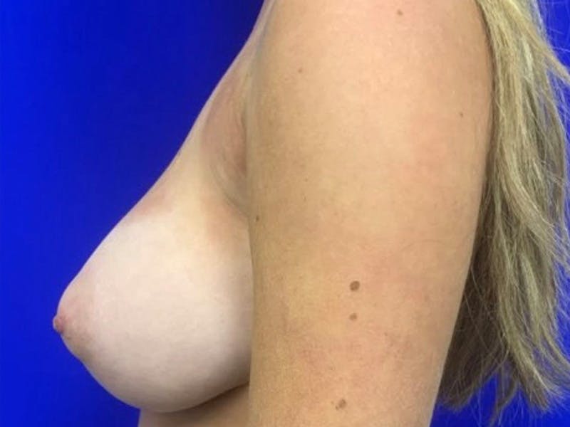 Breast Reduction Before & After Gallery - Patient 117382 - Image 9