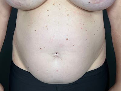 Abdomen Before & After Gallery - Patient 419008 - Image 1
