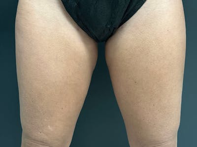 Thigh Lift Before & After Gallery - Patient 105155 - Image 1
