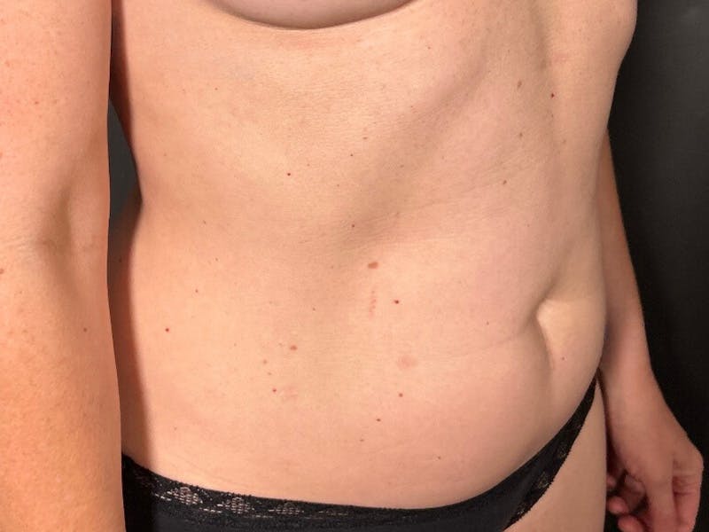Mini Tummy Tuck Before & After Gallery - Patient 418282 - Image 3